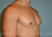 after right angle view gynecomastia of male patient 3286