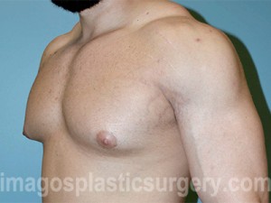 before left angle view gynecomastia of male patient 3292