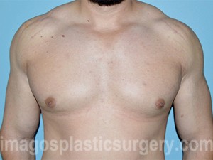 after front view gynecomastia of male patient 3292