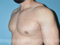 after left angle view gynecomastia of male patient 3292