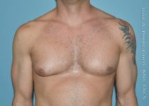 before front view gynecomastia of male patient 3298