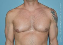 before front view gynecomastia of male patient 3298