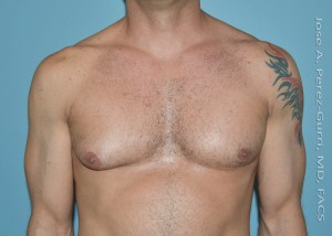 before front view gynecomastia of male patient 3298