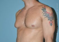 before left angle view gynecomastia of male patient 3298