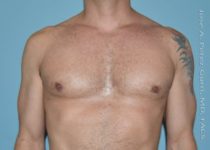 after front view gynecomastia of male patient 3298