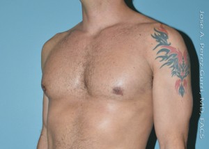 after left angle view gynecomastia of male patient 3298