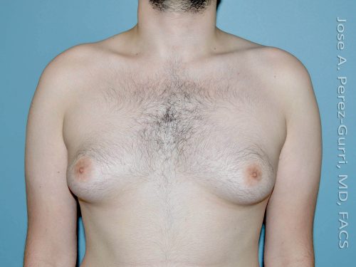 before front view gynecomastia of male patient 3303
