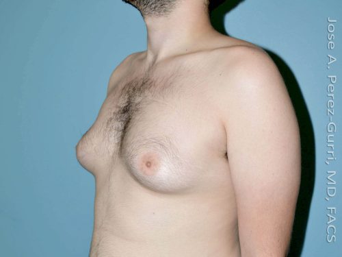 before left angle view gynecomastia of male patient 3303