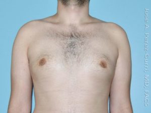 after front view gynecomastia of male patient 3303