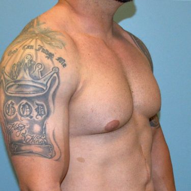 before right angle view gynecomastia of male patient 3323