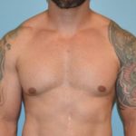 after front view gynecomastia of male patient 3323