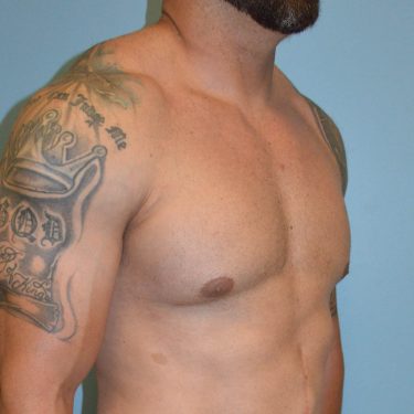 after right angle view gynecomastia of male patient 3323