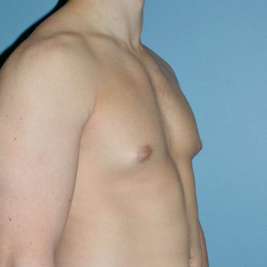 before right side view gynecomastia of male patient 3328