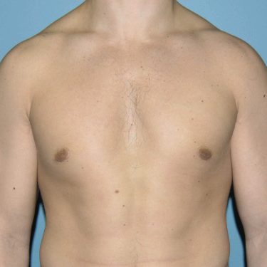 after front view gynecomastia of male patient 3328