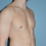 after right side view gynecomastia of male patient 3328
