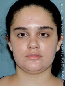 Before facial liposuction female patient front view case 3812