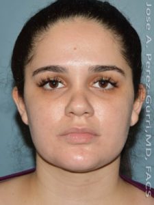 After facial liposuction female patient front view case 3812