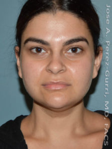 Before facial liposuction female patient front view case 3819