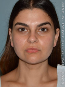 After facial liposuction female patient right front view case 3819