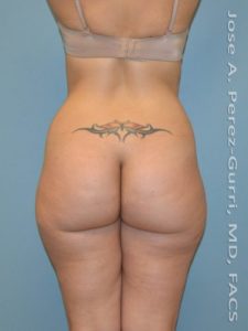Before liposuction back view female patient case 3826