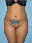 Before liposuction front view female patient case 3845
