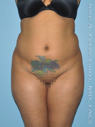 Before liposuction front view female patient case 3845