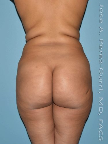 Before liposuction back view female patient case 3845