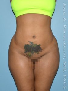 After liposuction front view female patient case 3845