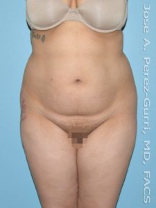 Before liposuction front view female patient case 3850