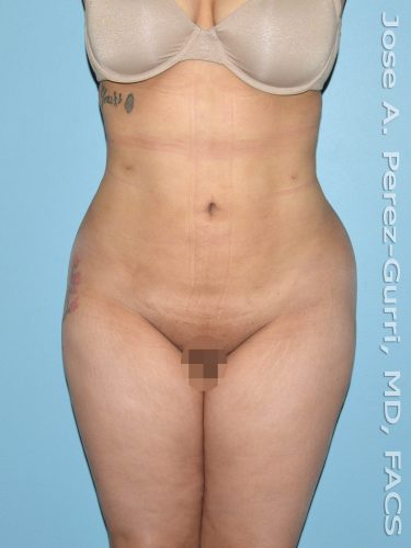 After liposuction front view female patient case 3850