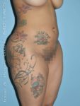 Before liposuction right 3/4 side view female patient case 3862