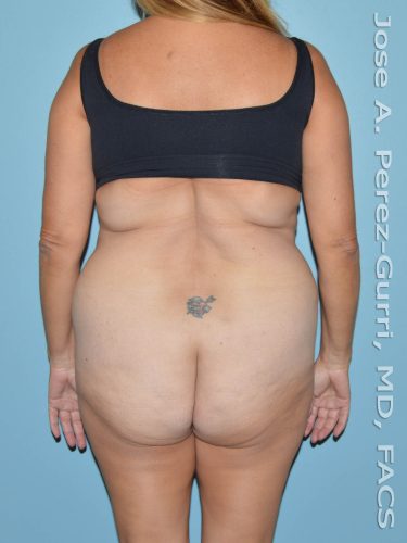 Before liposuction back view female patient case 3870