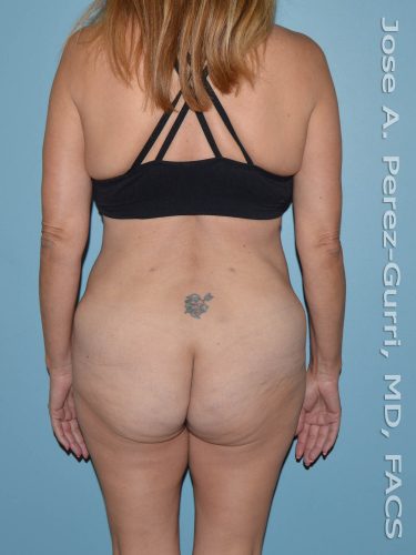 After liposuction back view female patient case 3870