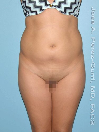 Before liposuction front view female patient case 3873