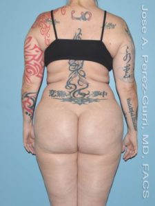 Before liposuction back view female patient case 3879