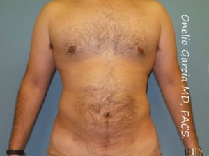 After liposuction front view male patient case 4229