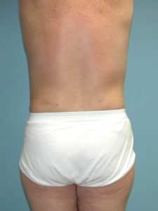 After liposuction male patient back view case 4262