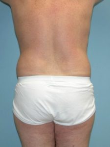 Before liposuction male patient back view case 4262