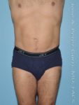After liposuction male patient front view case 4282