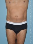 Before liposuction male patient front view case 4282