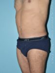 After liposuction male patient left 3/4 view case 4282