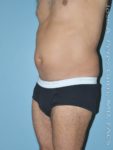 Before liposuction male patient left 3/4 view case 4282