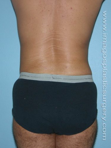 After liposuction male patient back view case 4292