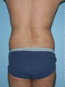 Before liposuction male patient back view case 4292