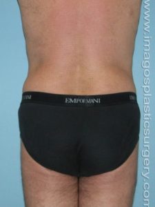After liposuction male patient back view case 4295