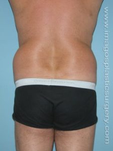 Before liposuction male patient back view case 4299