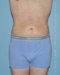 After liposuction male patient front view case 4299