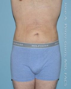 After liposuction male patient front view case 4299