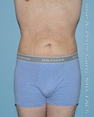 After liposuction male patient front view case 4299