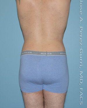AFter liposuction male patient back view case 4299